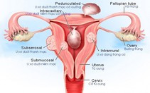 U xơ tử cung ở phụ nữ độc thân