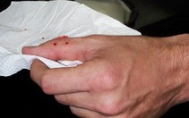 Cách xử trí khi “đụng độ” rắn