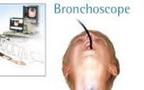 Tử vong sau khi nội soi phế quản ở Bệnh viện Bạch Mai