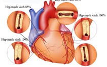 Hiểu biết về bệnh động mạch vành
