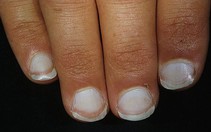 Hội chứng thiếu máu và cách nhận biết