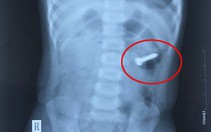 Bé gái 2 tuổi nuốt đinh xoắn 3cm
