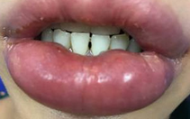 Lại một phụ nữ gặp tai biến vì bơm môi ở thẩm mỹ viện