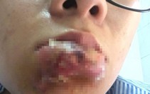 Bát nháo dịch vụ làm đẹp - Kỳ 2: Tiền mất tật mang