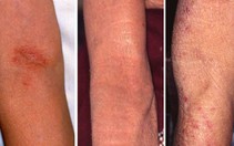 Phòng ngừa bệnh ngoài da mùa hanh khô ở người cao tuổi
