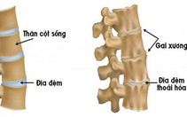 Chữa gai cột sống, vôi hóa cột sống