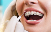 Vì sao cần nắn chỉnh răng?
