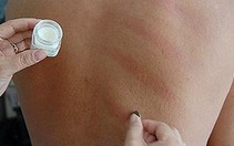 Lương y chỉ cách cạo gió đúng cách, không đau