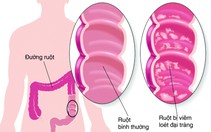 Bào tử lợi khuẩn LiveSpo COLON hỗ trợ điều trị viêm đại tràng