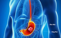 Không nên quá lo lắng tác dụng phụ của hóa trị