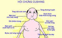 Hội chứng Cushing và bệnh Cushing