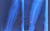 Bé trai 5 tuổi bị 'đạn lạc' súng hơi găm vào tay
