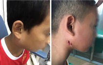 Phát hiện số ca bệnh whitmore do vi khuẩn 'ăn thịt người' đang gia tăng