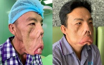 Tìm ra căn bệnh cho chàng trai suốt 15 năm mang thân phận 'mặt quỷ'