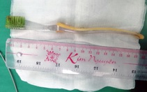 Gắp bàn chải đánh răng dài gần 20cm khỏi dạ dày bé gái 13 tuổi