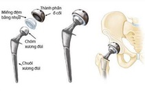 Khớp háng nhân tạo - cứu cánh giúp bệnh nhân gãy cổ xương đùi tránh tàn phế
