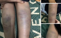Không khởi tố vụ án hình sự vụ học sinh lớp 1 bị đánh bầm tím chân tay ở trường