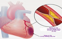 Thông tin cần biết về nhồi máu cơ tim cấp