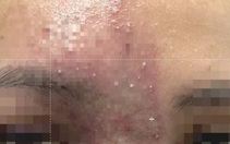 Tiêm filler nâng mũi 'ủng hộ' spa quen, ngờ đâu hoại tử mũi nghiêm trọng