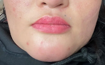 Tiêm filler cằm, người phụ nữ bị nhiễm trùng, chảy đầy dịch mủ trong miệng