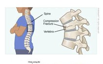 Loãng xương - căn bệnh bị xem nhẹ nhưng tỉ lệ tử vong cao