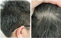 Có phải ‘tóc bạc nhiều là dấu hiệu của ung thư’?
