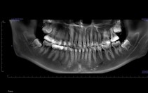Bác sĩ hướng dẫn tránh sai lầm sau nhổ răng khôn - 'vị khách' đến muộn nhiều phiền toái