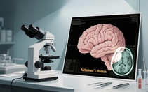 Trung Quốc đình chỉ phương pháp phẫu thuật điều trị Alzheimer phổ biến