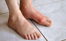 Chàng trai trẻ mắc bệnh gout ở tuổi 22, dấu hiệu cảnh báo từ đau khớp cổ chân
