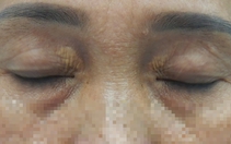 Mí mắt nổi mảng màu vàng, coi chừng rối loạn lipid máu