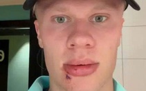 Erling Haaland khâu 3 mũi sau tai nạn hy hữu