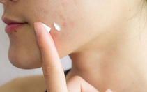 Thu hồi 8 sản phẩm mỹ phẩm chứa thuốc chống nấm trên toàn quốc