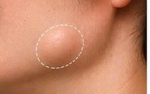 Thấy khối u mỡ ở vùng đầu, cổ: Khi nào đáng lo?