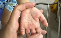 Báo động trẻ tử vong vì bệnh tay chân miệng tăng nhanh