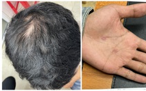 Lo ngại tóc rụng, tóc mỏng, yếu, nhưng bạn có biết loại trái cây giàu dinh dưỡng có lợi cho tóc?