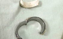 Cấp cứu nam thanh niên bị thắt nghẹt dương vật do đeo 'cock ring'