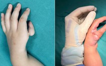 Bé gái được ‘tạo ngón cái mới’ từ ngón trỏ