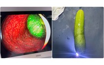 Nam sinh lớp 9 nhập viện vì 'nghịch dại', đưa quả dưa chuột dài 20cm vào hậu môn