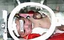 BV Nhi TƯ sẽ mổ cho cháu bé có tim ngoài lồng ngực