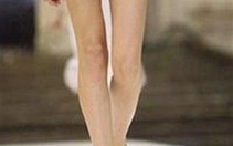 Rối loạn ăn uống - giá của cái đẹp