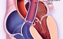 Dị tật tim bẩm sinh "còn ống động mạch"