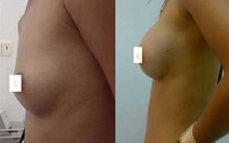 Thắc mắc chuyện "nâng gò"