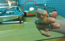 Ù tai do cục ráy tai quá lớn