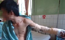 Nối thành công bàn tay bị chém đứt lìa