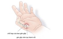 Tật ngón tay cò súng ở trẻ em: Sau 3 tuổi, phải mổ mới hết