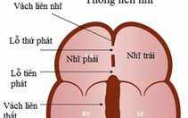 Em bé bị thông liên nhĩ lỗ thứ hai có thể chữa khỏi