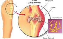 Chế độ ăn giúp giảm acid uric trong máu
