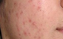 Khám mụn, bác sĩ cho thuốc trị xơ gan ứ mật, sỏi mật?