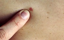 ​Australia phát triển phương pháp chẩn đoán nhanh ung thư da
