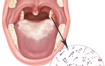 Xác nhận dịch bạch hầu tại Quảng Nam